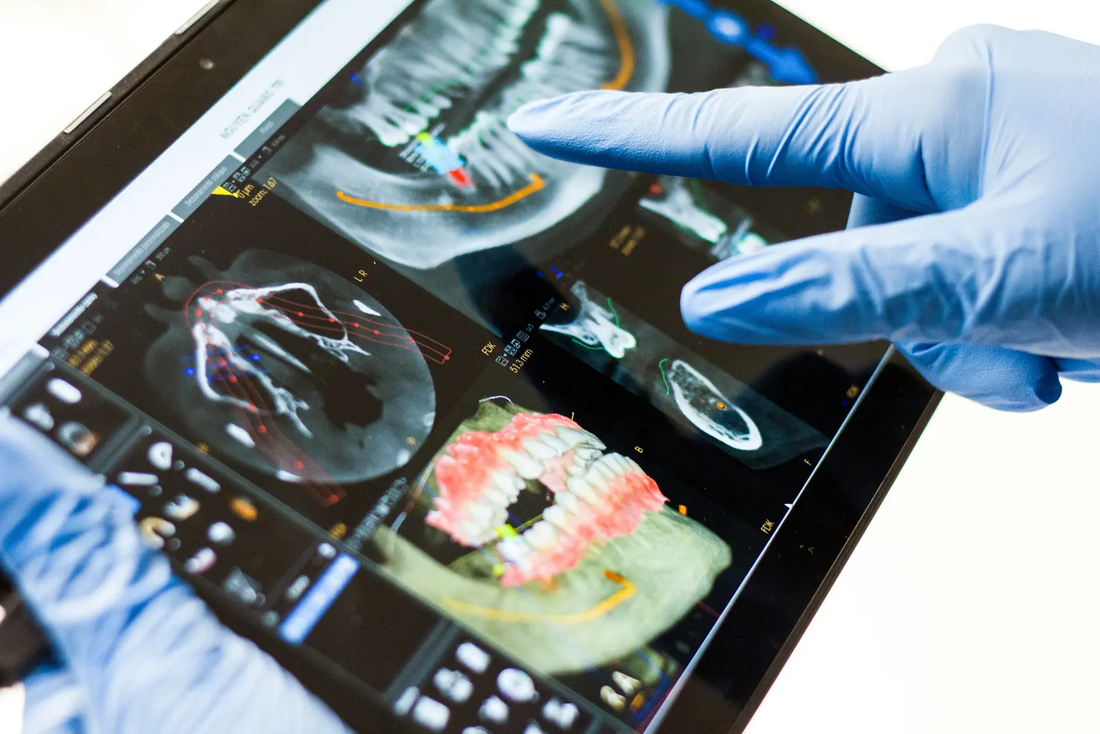 CBCT implant planning reviewed on a tablet, shown while covering Implants In Toronto in Toronto