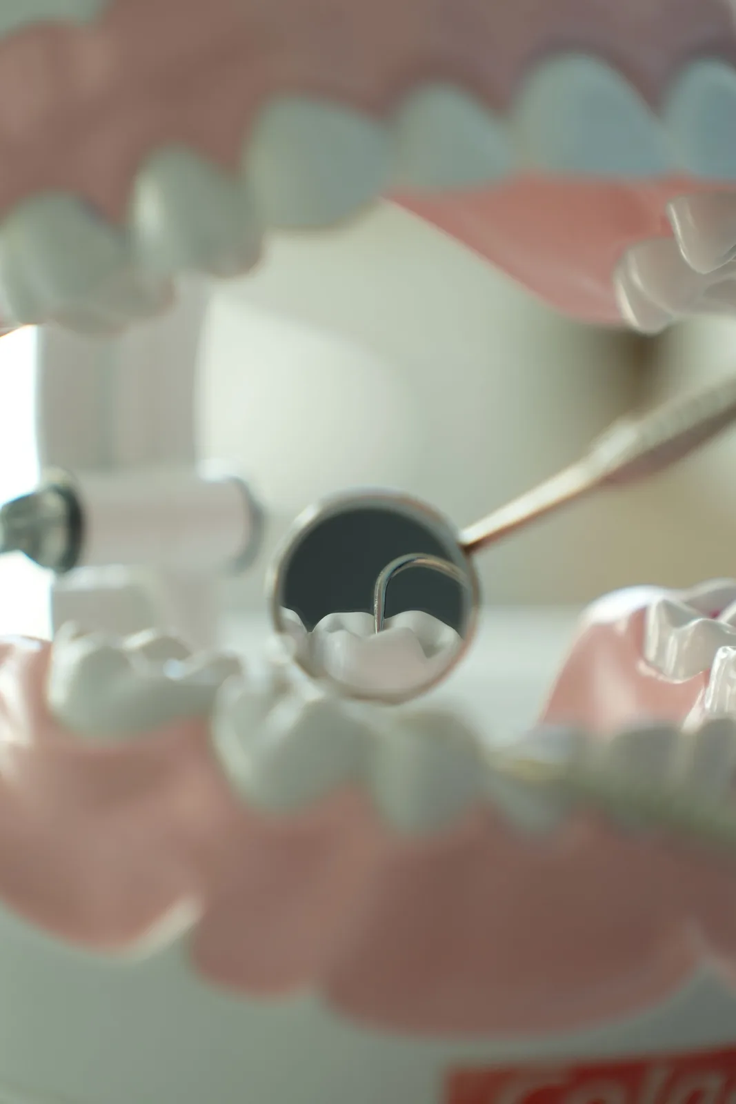 Dental mirror view inside the mouth, referred to in the Bone Grafting section for Toronto