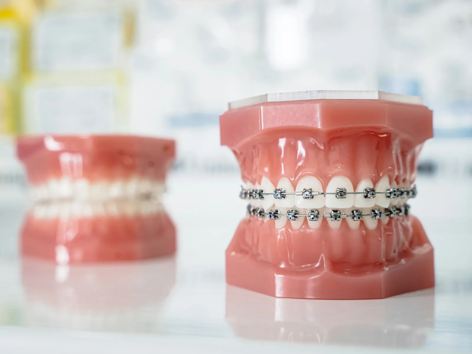Dental study models at the practice, alongside the Same Day Implants explanation in Toronto
