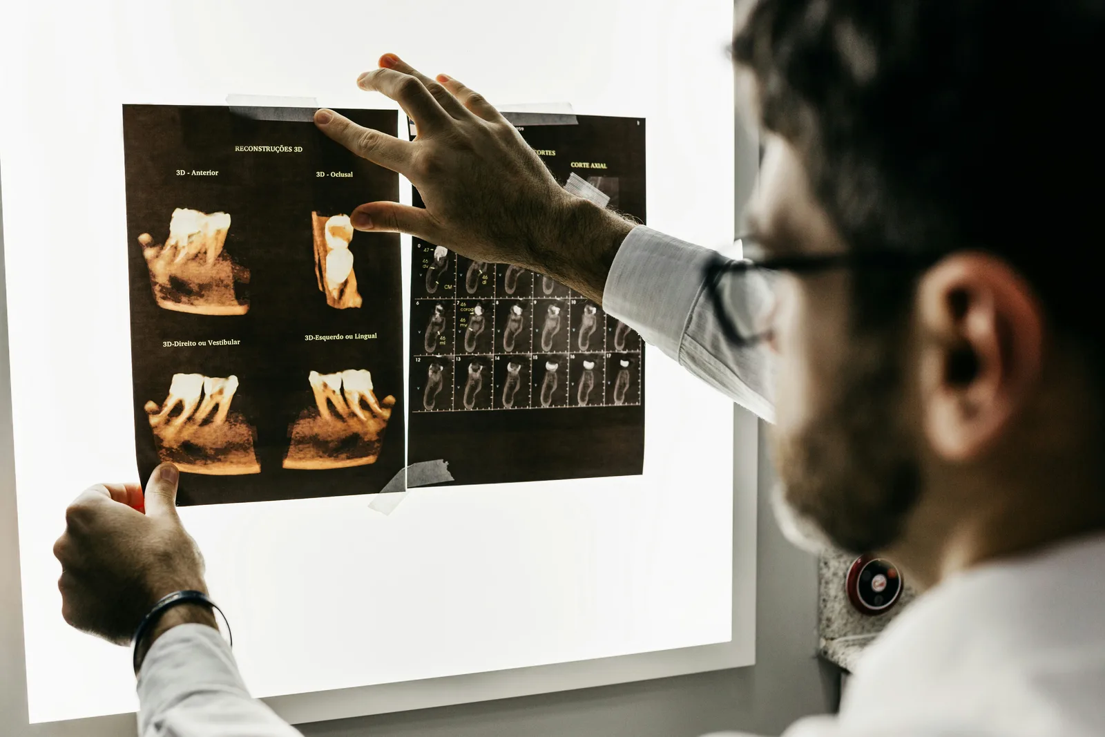 Dentist reviewing a CBCT scan before implant surgery, alongside the dental implant treatment explanation in Toronto
