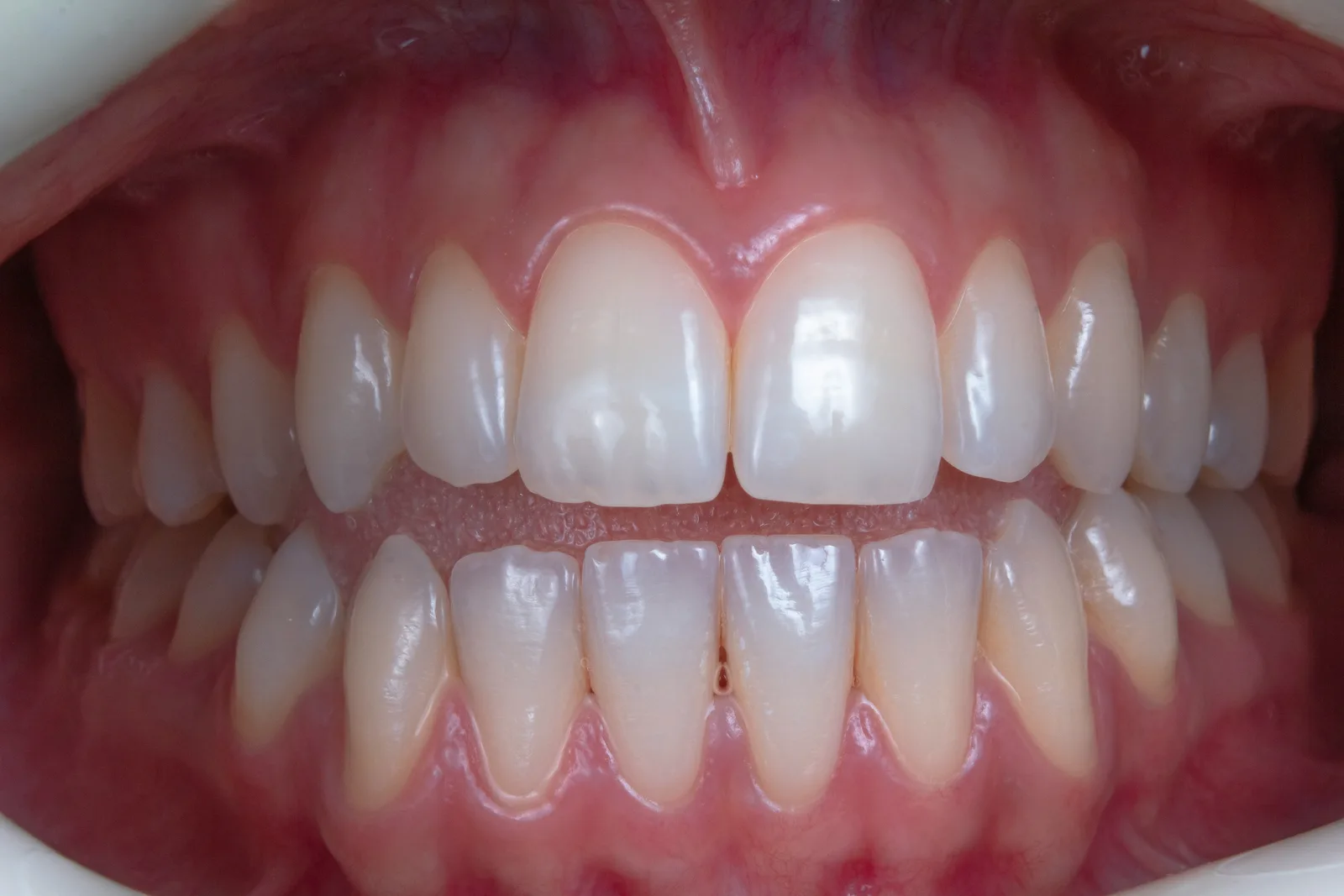 Full arch intraoral view of the teeth, shown while covering Implant Financing in Toronto