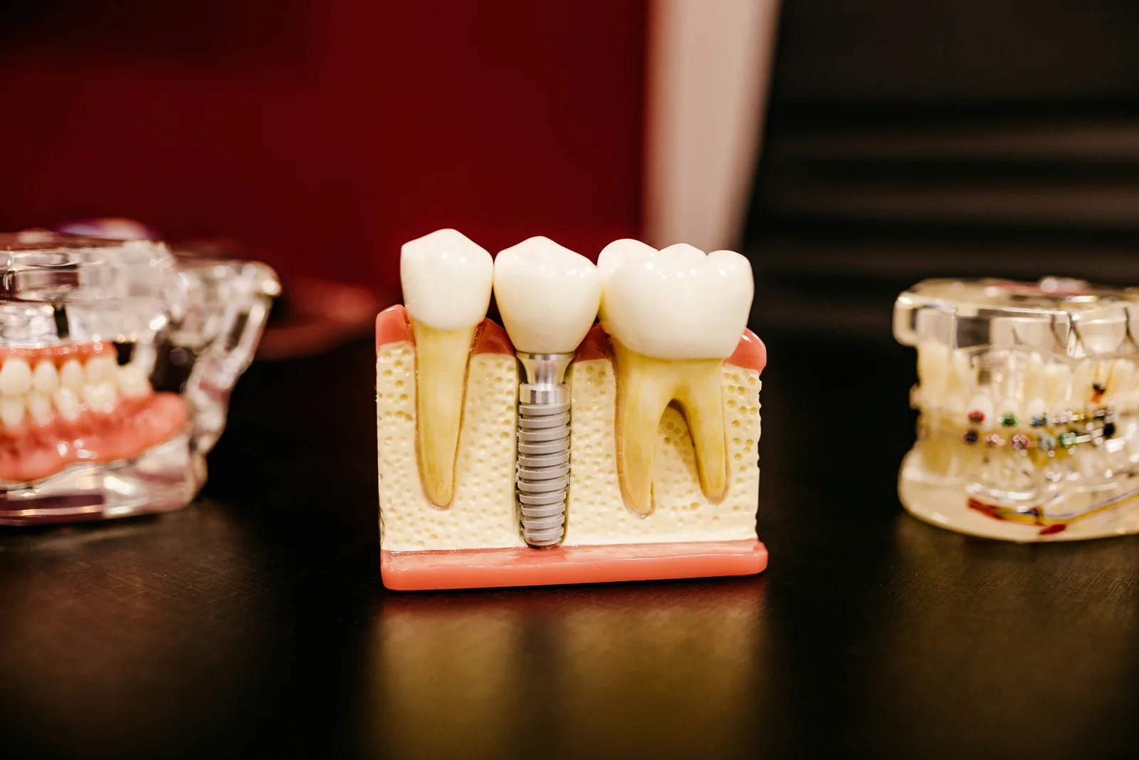Cross-section model showing an implant in the jawbone, shown while covering dental implant treatment in Toronto