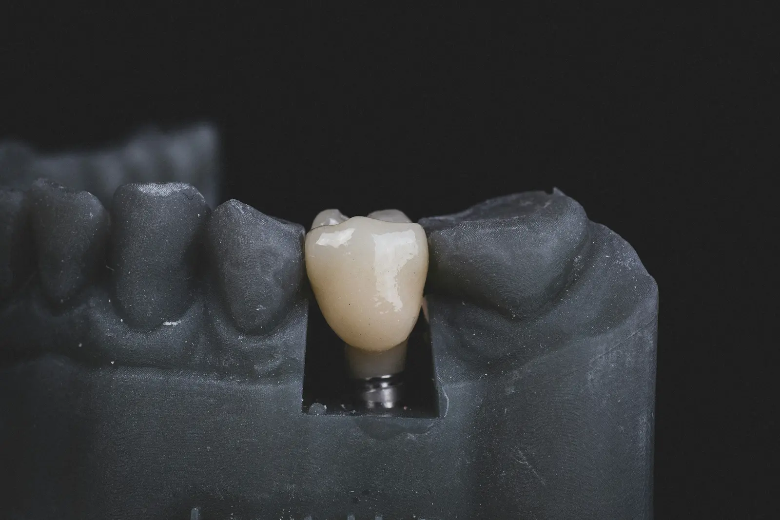 Implant crown seated on a working model, shown while covering Implant Services in Toronto