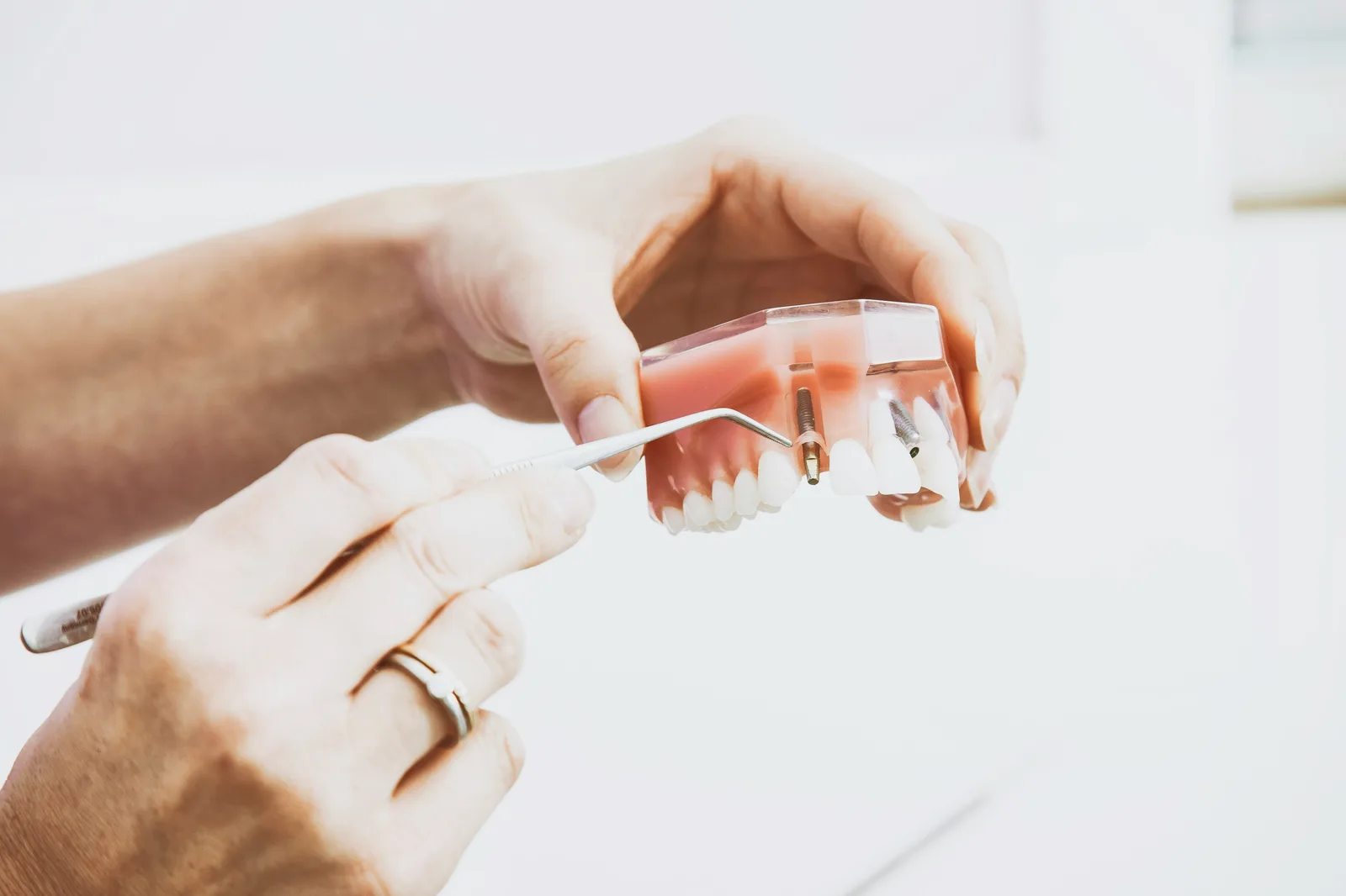 Implant model examined with a dental probe, shown while covering Guided Implant Surgery in Toronto
