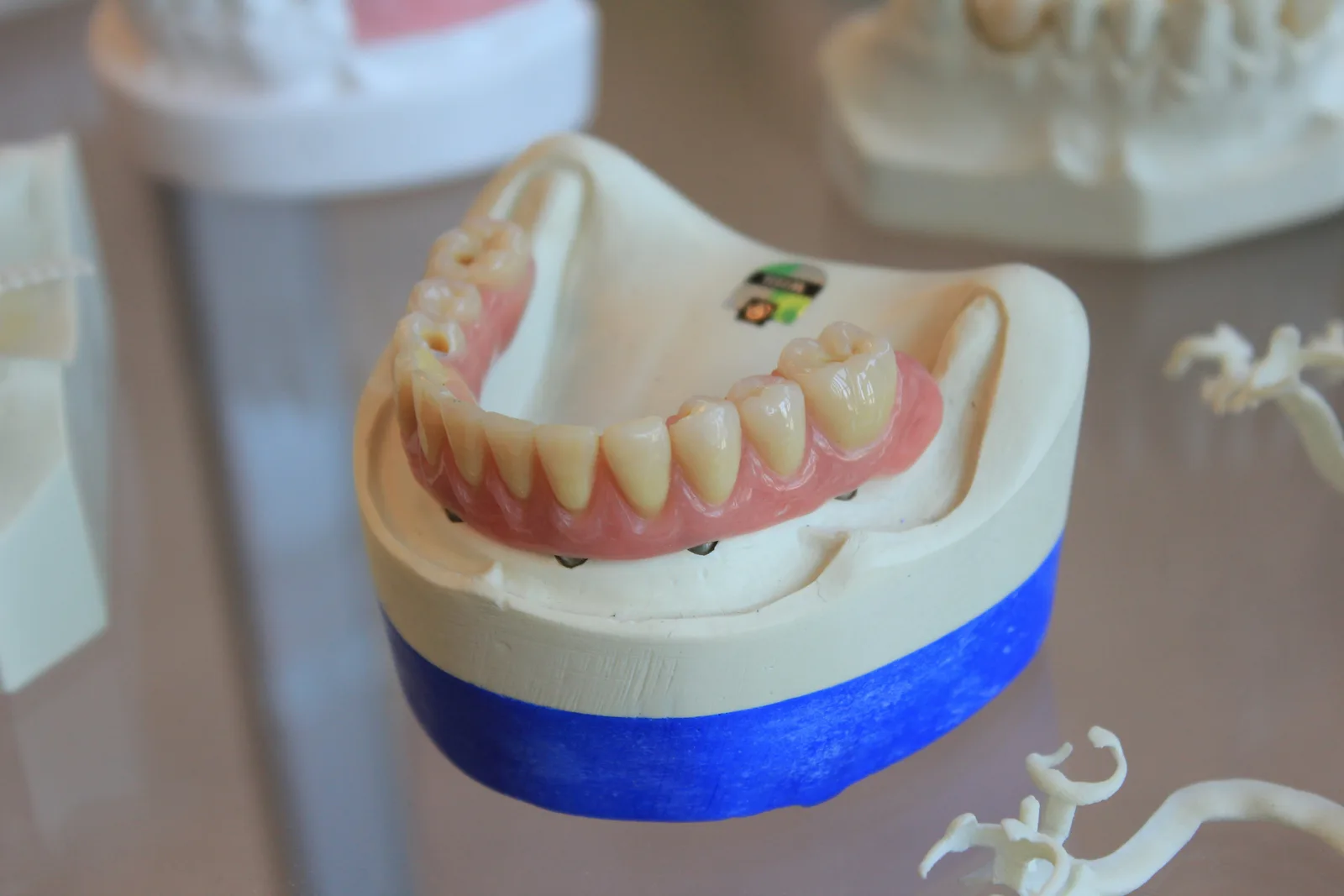 Implant supported denture on a study model, referred to in the Implants In Toronto section for Toronto