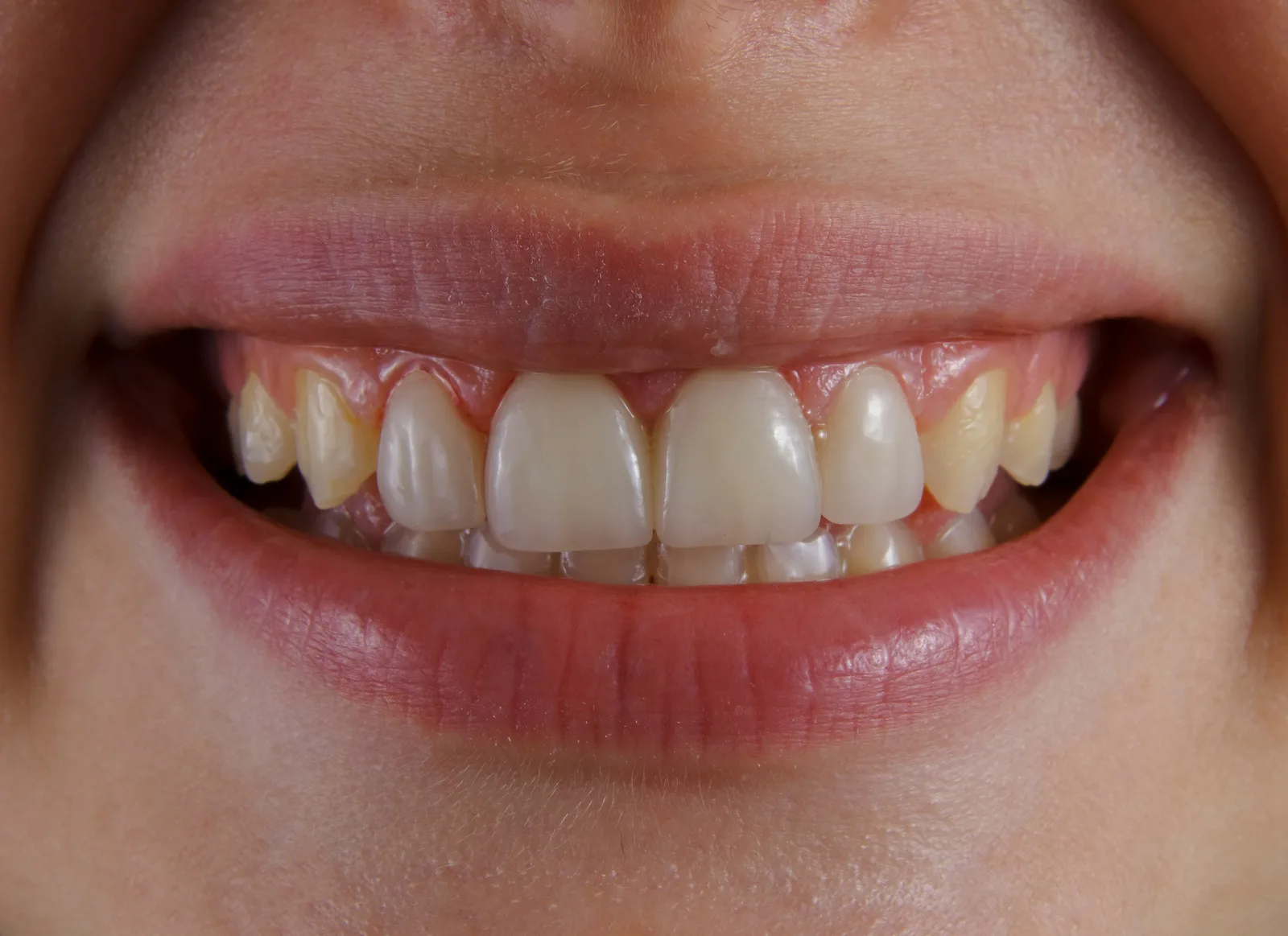 Close-up of a natural smile, referred to in the Guided Implant Surgery section for Toronto