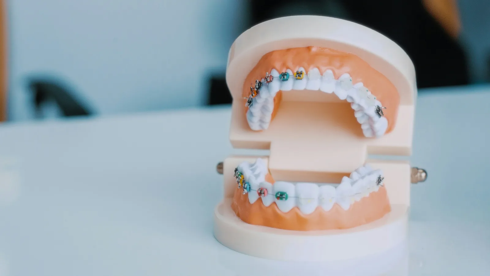 Dental model of the upper and lower arch, alongside the Implants In Toronto explanation in Toronto