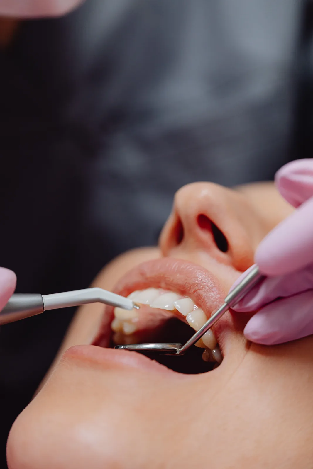 Polishing the teeth after treatment, shown while covering Tooth Extraction Implant in Toronto