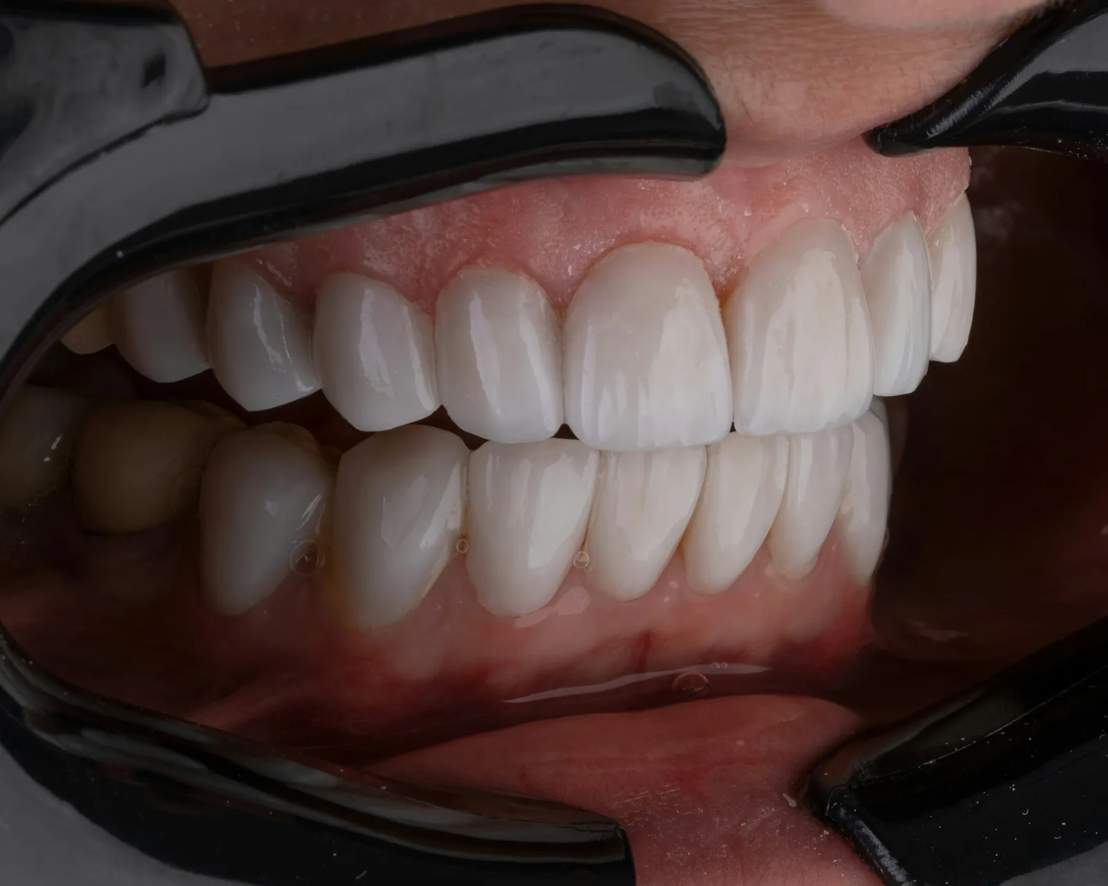 Intraoral view of several restored teeth in one arch, after multiple tooth implants in Toronto