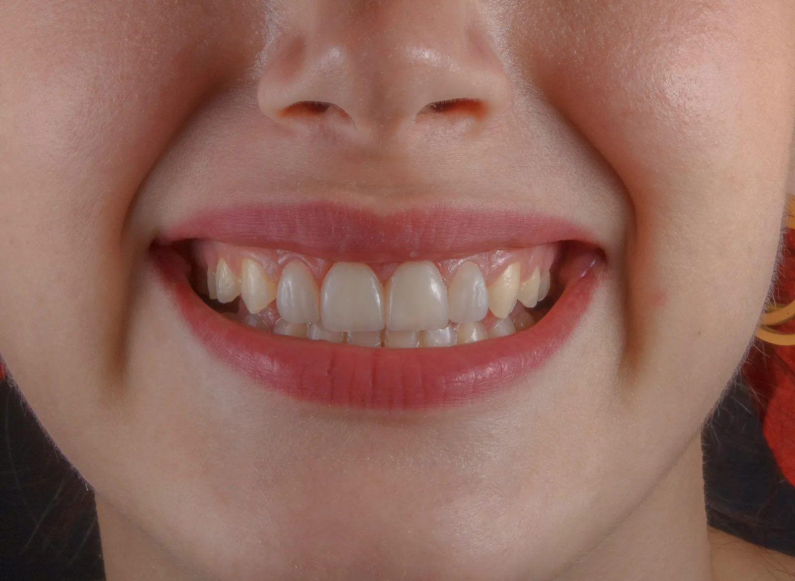 Close-up of a smile before treatment, referred to in the Implant Financing section for Toronto