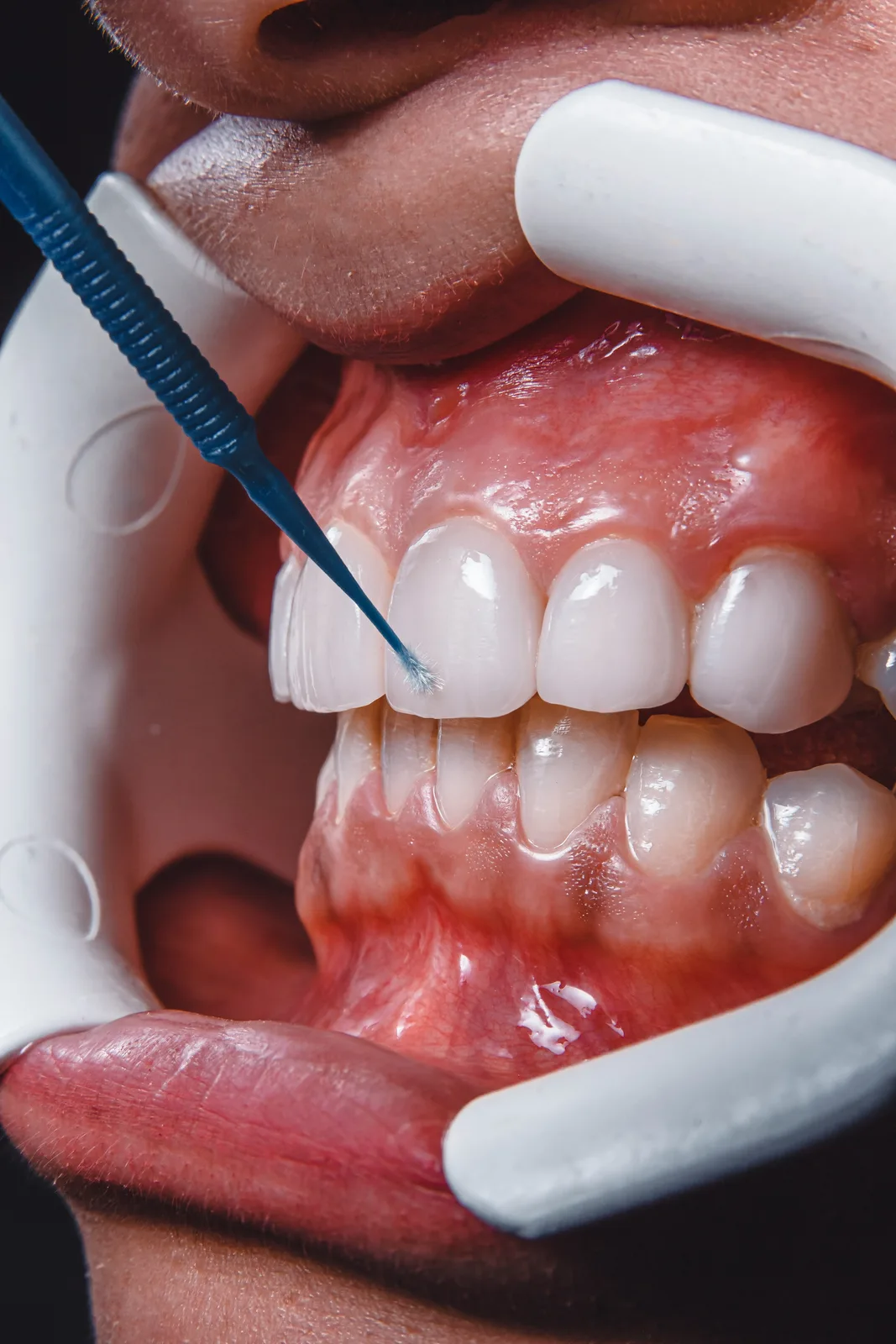 Tooth preparation with cheek retractors in place, alongside the Guided Implant Surgery explanation in Toronto