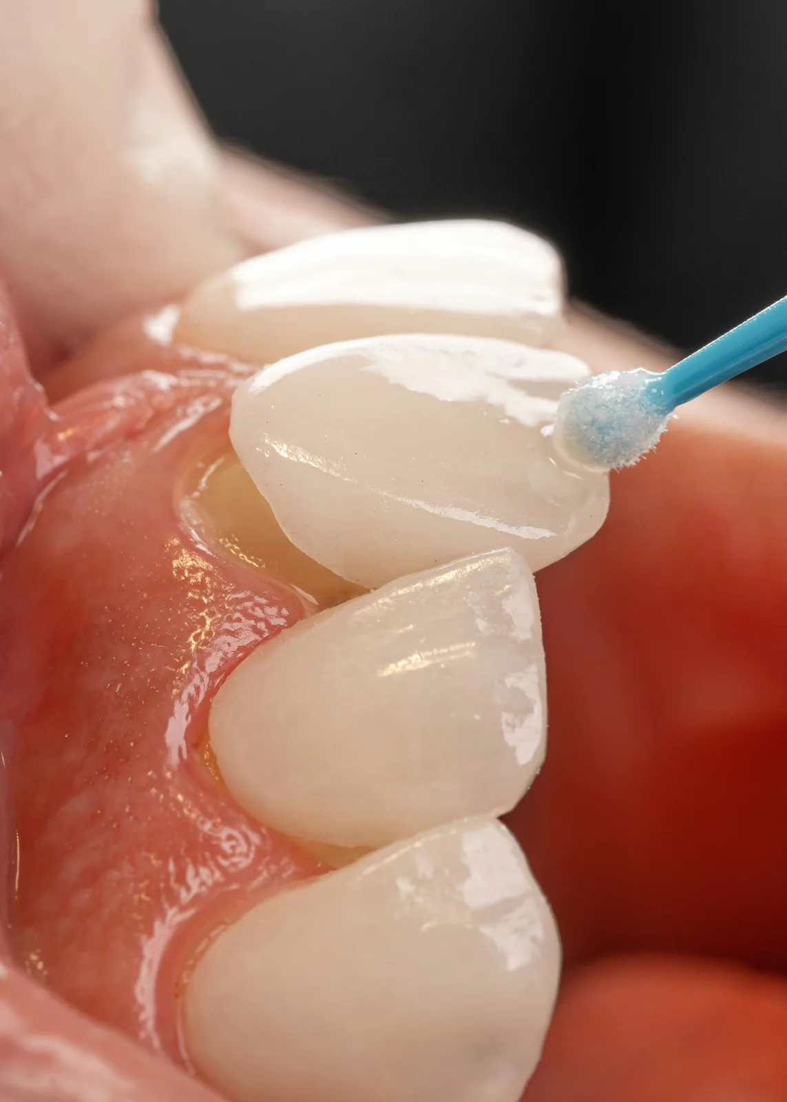 Close-up of tooth surface preparation, referred to in the What Are Dental Implants section for Toronto